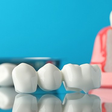 A dental bridge and dental implant model
