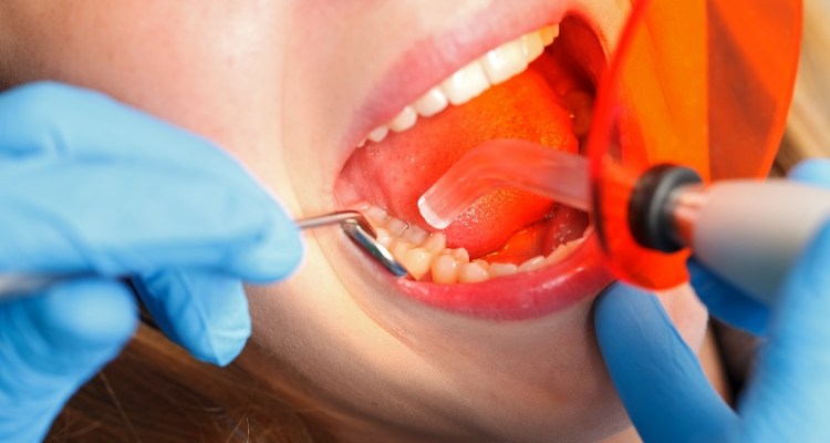 Close up of patient having cosmetic dental bonding hardened with curing light