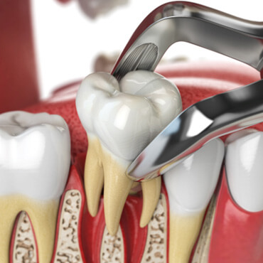 digital image of a tooth being removed