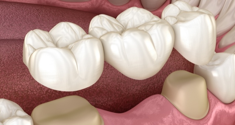 Illustrated dental bridge being placed in the mouth