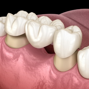 Illustrated traditional dental bridge being fitted over two natural teeth