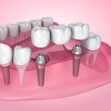 Illustrated dental bridge being fitted over two dental implants