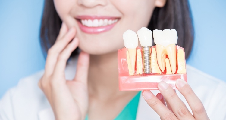 Dentist holding model of jaw with a dental implant in Grapevine