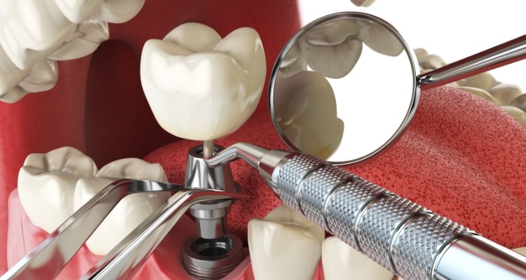 Illustrated model of dental implant abutment and crown being placed in lower jaw