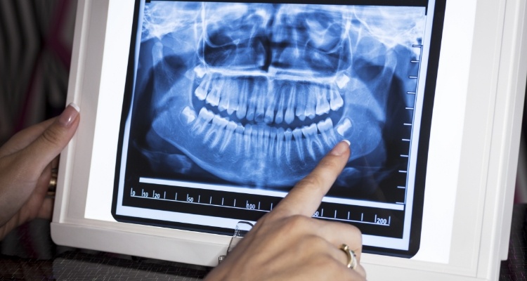 Person pointing to impacted wisdom tooth in dental x ray