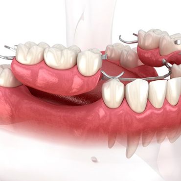 Dentures in glass of water on tabletop