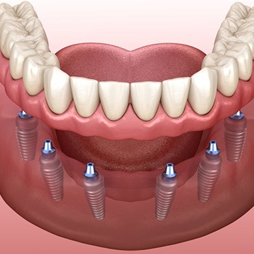 Illustration of full implant dentures