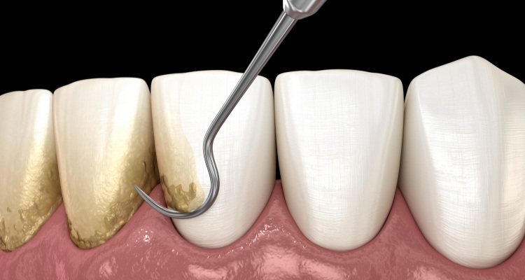 Illustrated dental instrument removing plaque buildup from teeth