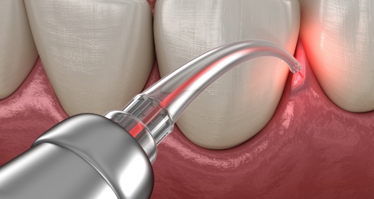 Illustrated soft tissue laser treating gum disease