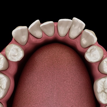 3D graphic of crowded teeth 