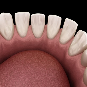 3D graphic of gaps between teeth 