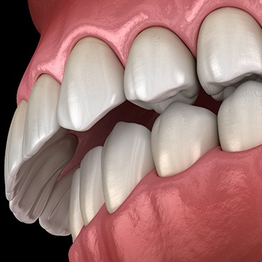 3D graphic of overbite