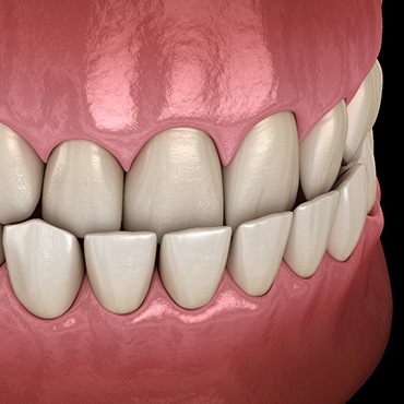 3D graphic of underbite 