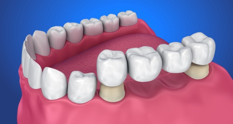 Illustrated dental bridge being placed in the mouth to replace two missing teeth