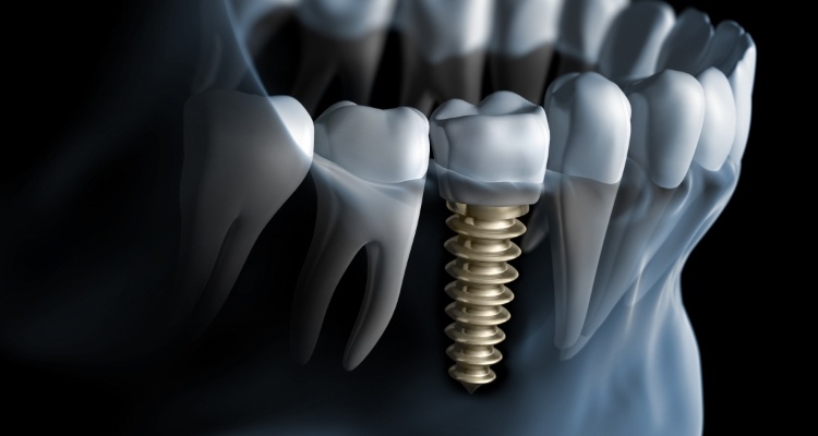 Illustrated x ray of person with a dental implant replacing a missing tooth