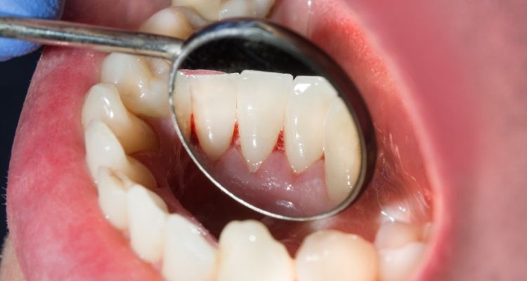 Close up of dental mirror inside of mouth