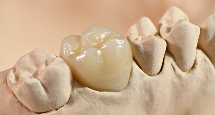 Model of the mouth with a dental crown over one tooth