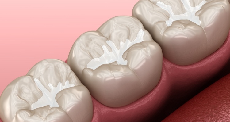 Illustrated row of teeth with tooth colored fillings