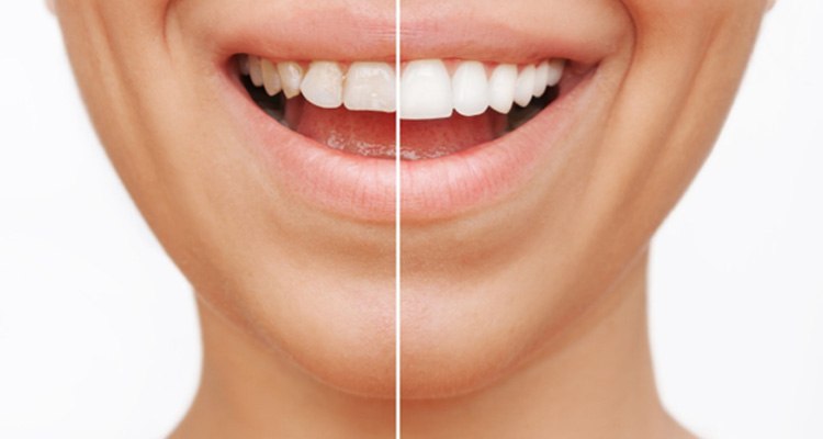 Closeup of patient's smile before and after veneers