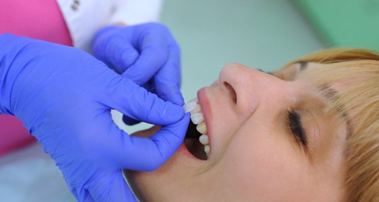 Dentist with blue gloves placing veneers on patient's teeth