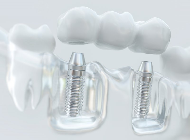Model of dental implants supporting dental bridge