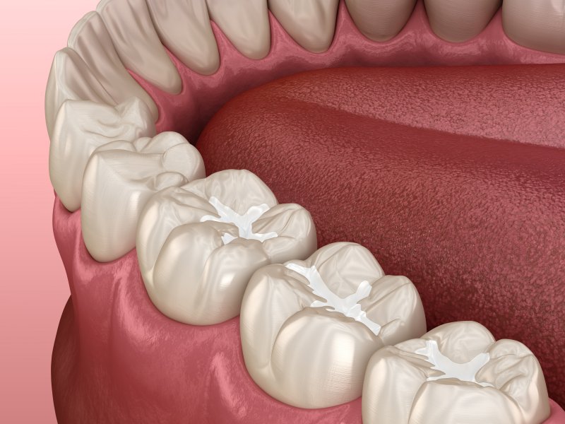 digital image of dental fillings